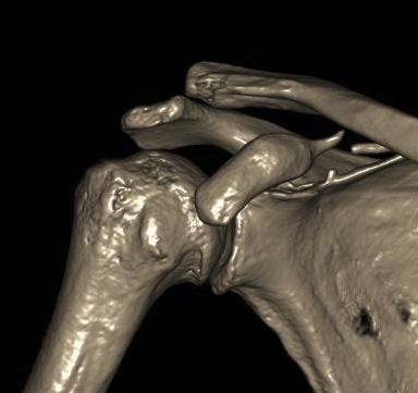 Coracoid Fracture CT 2